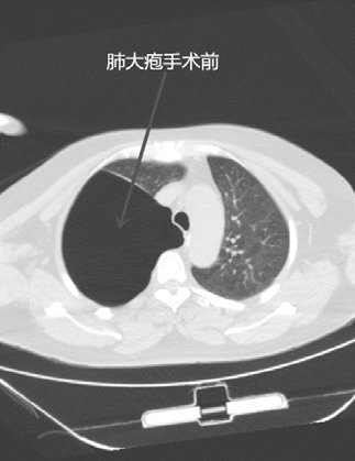 胸外科病區(qū)單孔胸腔鏡下切除巨大肺大皰一例