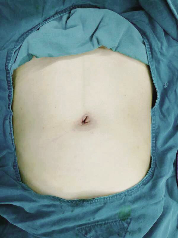 不留瑕疵的手术――单孔腹腔镜手术