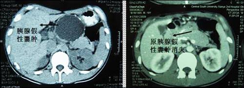 普外科治疗胰腺假性囊肿有新进展