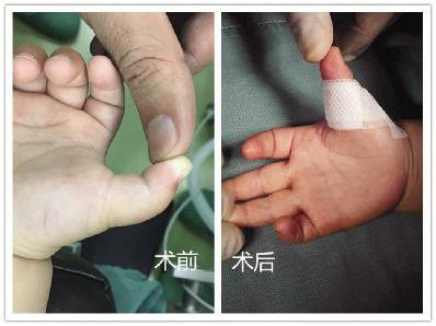近日,一名1 岁的宝宝右手大拇指不能伸直,在我院被确诊为拇指屈肌腱