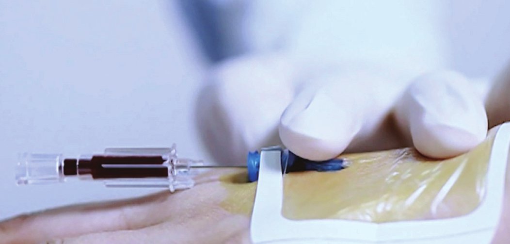 y型留置针为什么比直型留置针贵奇妙的1=5_https://www.jmylbn.com_新闻资讯_第1张